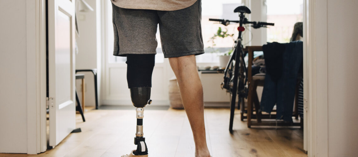 A photograph of a man from the waist down who is facing away from the camera. He has his hands in the pockets of his shorts. His left leg is a prosthetic.